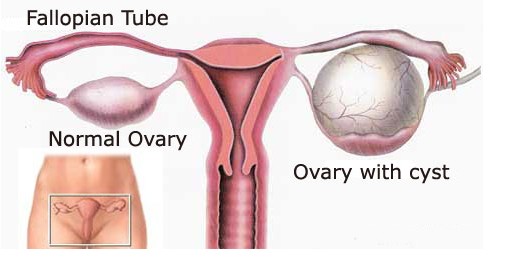 Photo of ovarian cysts in my guide for How to Shrink an Ovarian Cyst Naturally